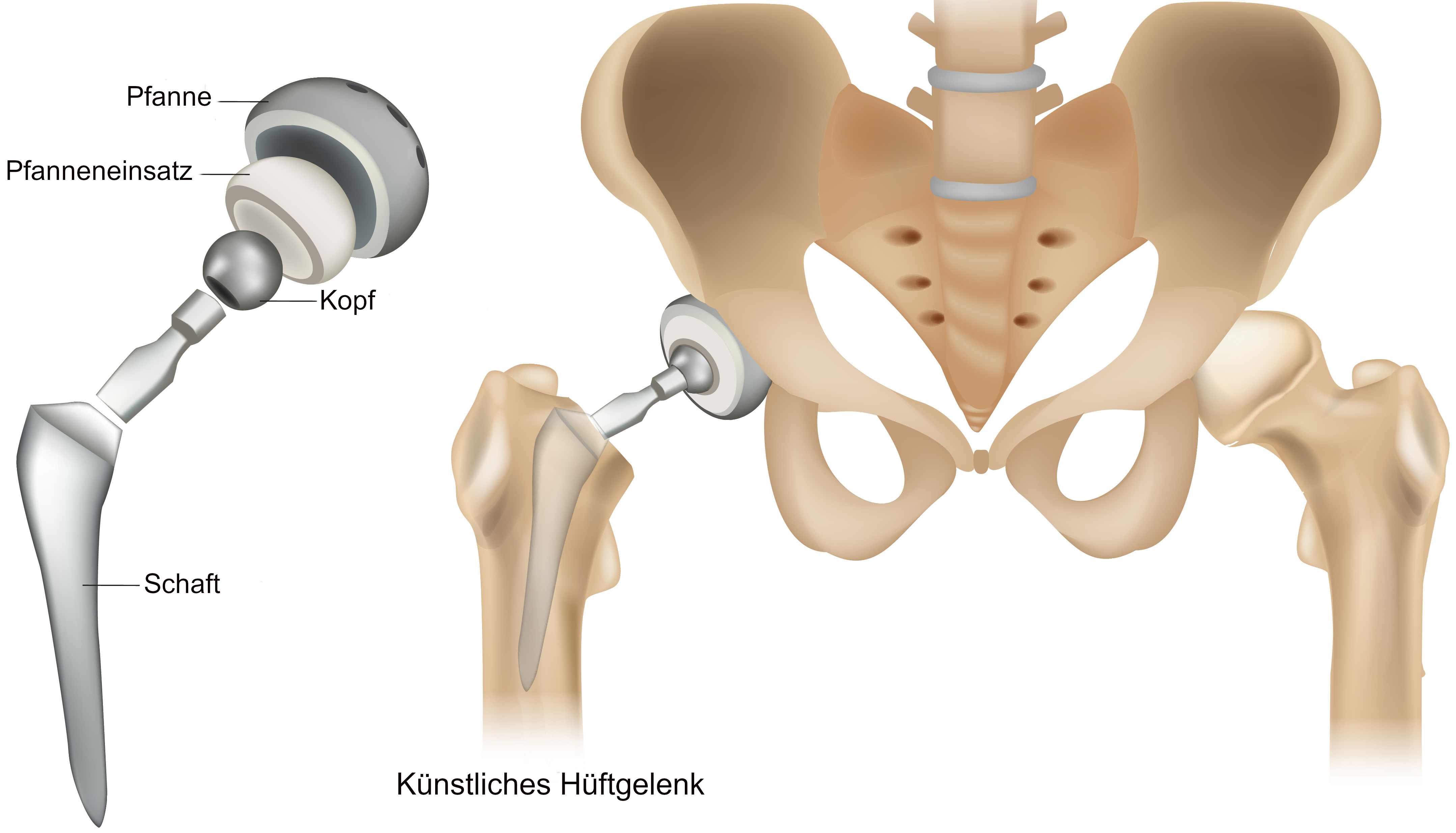Grafik Prothese eines Hüftgelenkes