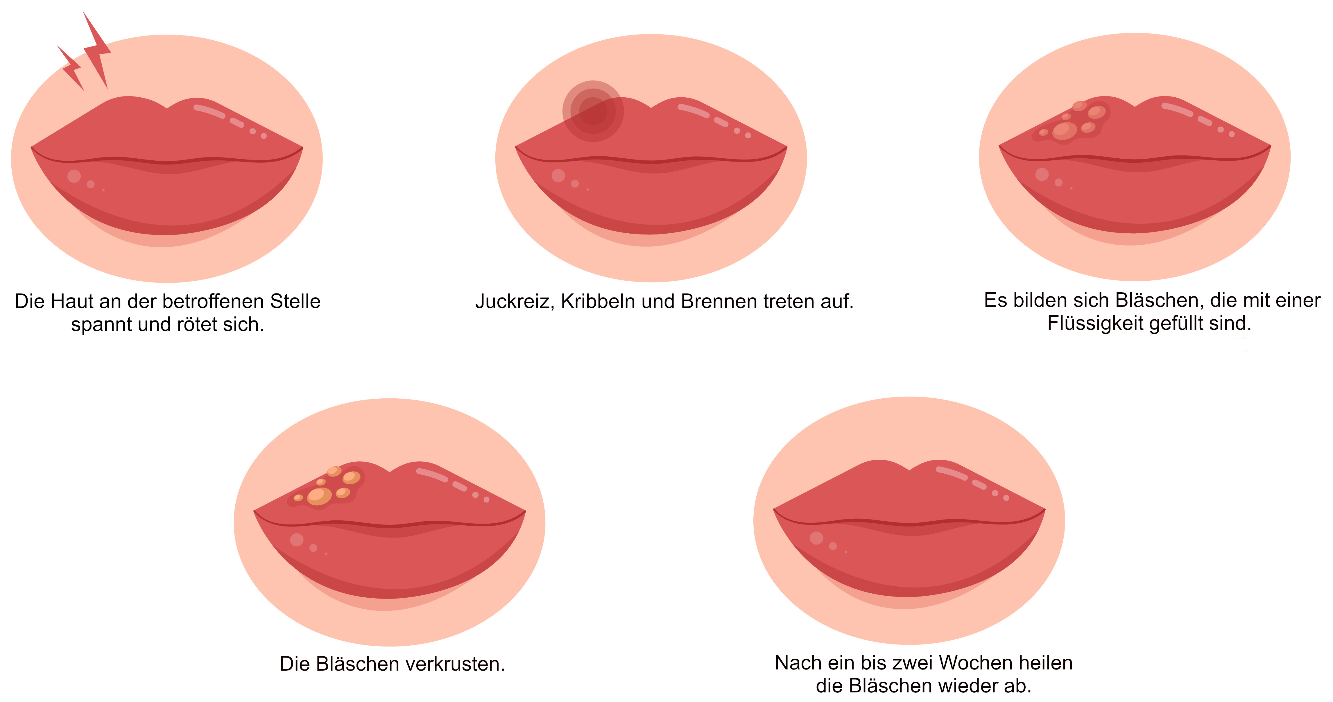 Grafik Fieberblase Verlauf